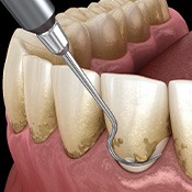 a 3D illustration of scaling & root planing