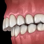 Illustration of an overbite