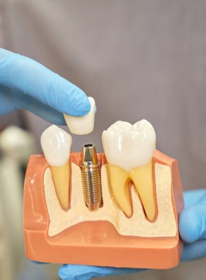 dentist placing a crown onto a model of a dental implant