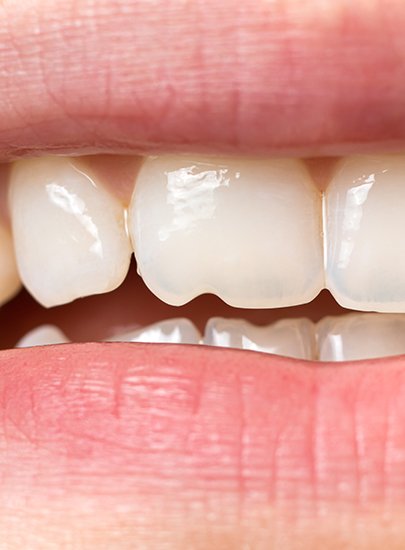 Up-close view of a minor chipped tooth