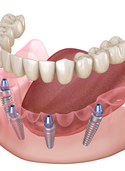 Illustration of implant dentures in Chula Vista, CA being attached