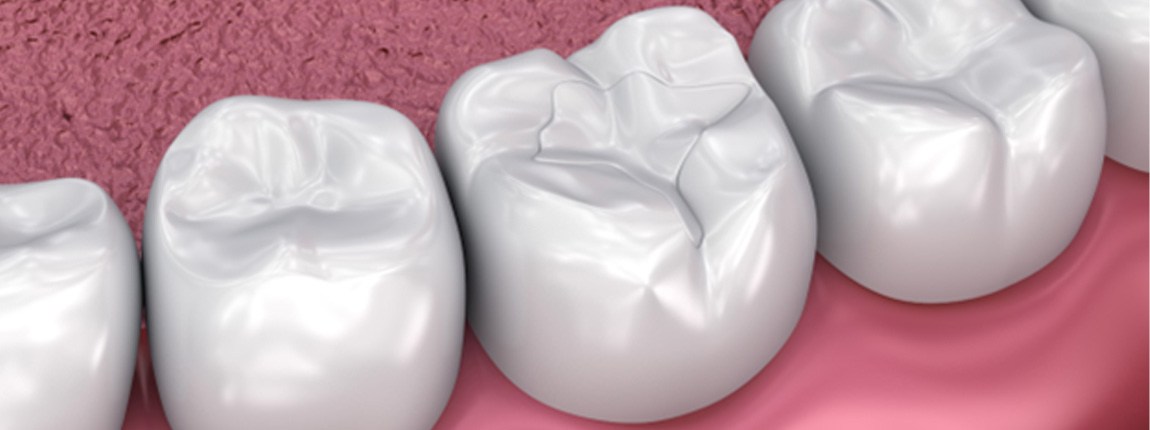 Tooth-colored filling on molar