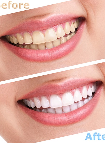 Before and after teeth whitening