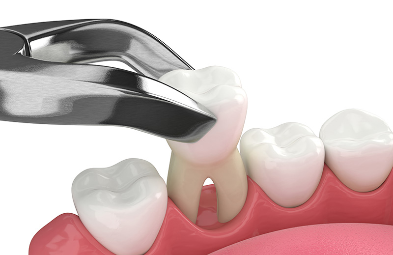Rendering of dental tool extracting tooth.