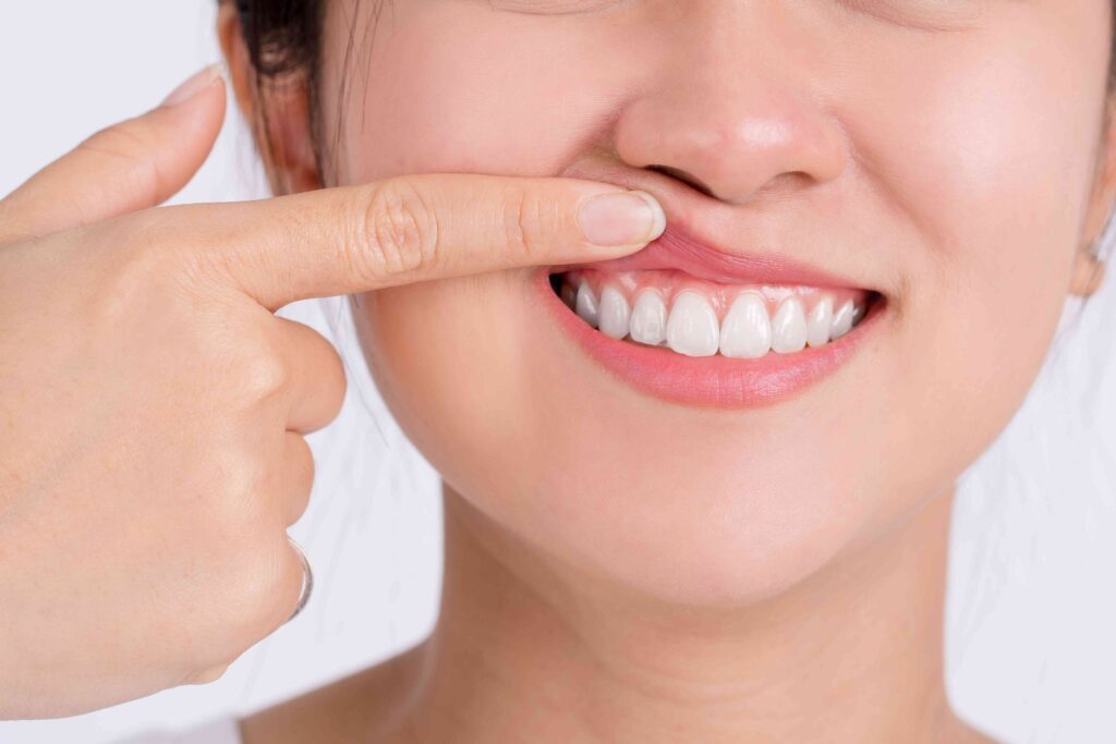 Woman with gum recession